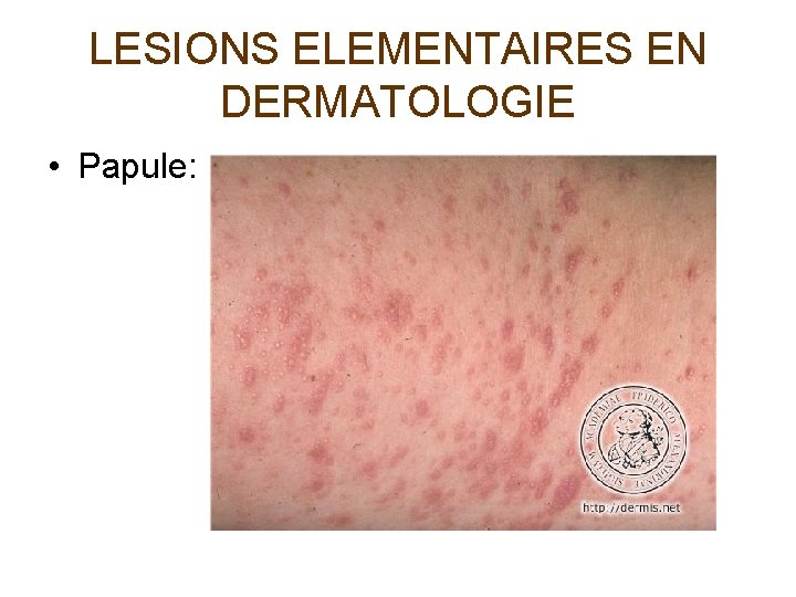 LESIONS ELEMENTAIRES EN DERMATOLOGIE • Papule: 