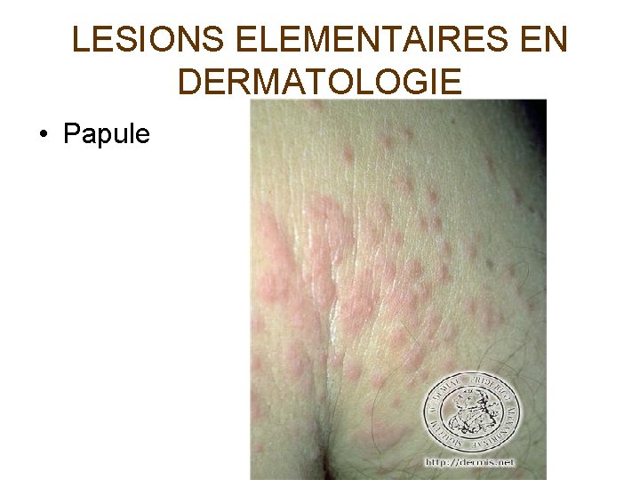 LESIONS ELEMENTAIRES EN DERMATOLOGIE • Papule 