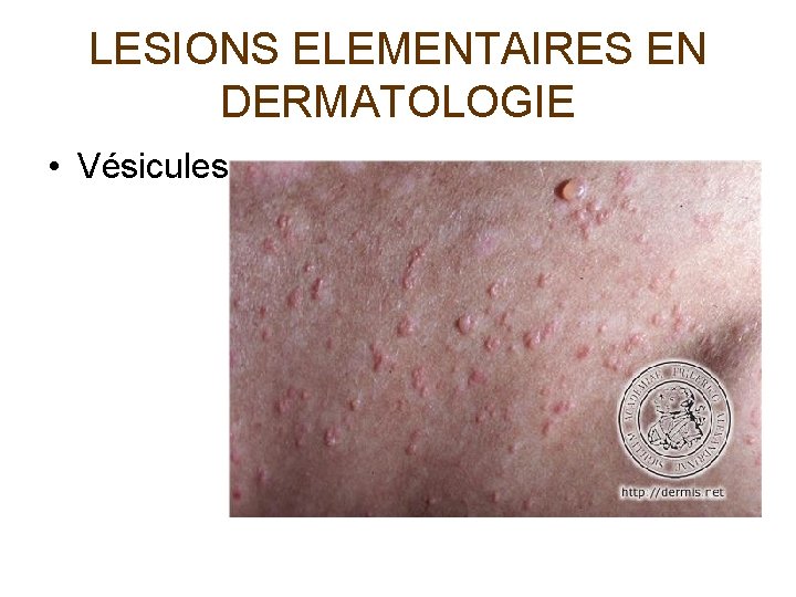 LESIONS ELEMENTAIRES EN DERMATOLOGIE • Vésicules 