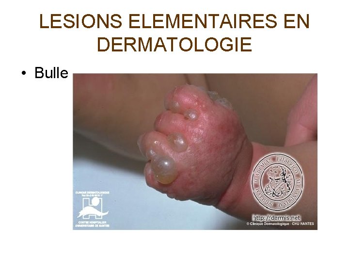 LESIONS ELEMENTAIRES EN DERMATOLOGIE • Bulle 