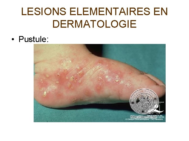 LESIONS ELEMENTAIRES EN DERMATOLOGIE • Pustule: 