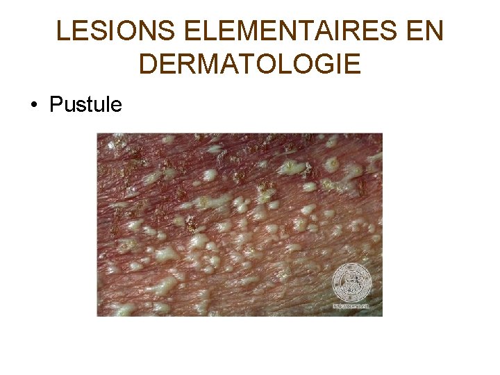 LESIONS ELEMENTAIRES EN DERMATOLOGIE • Pustule 