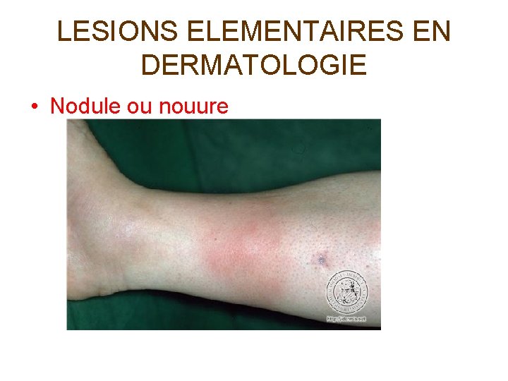 LESIONS ELEMENTAIRES EN DERMATOLOGIE • Nodule ou nouure 