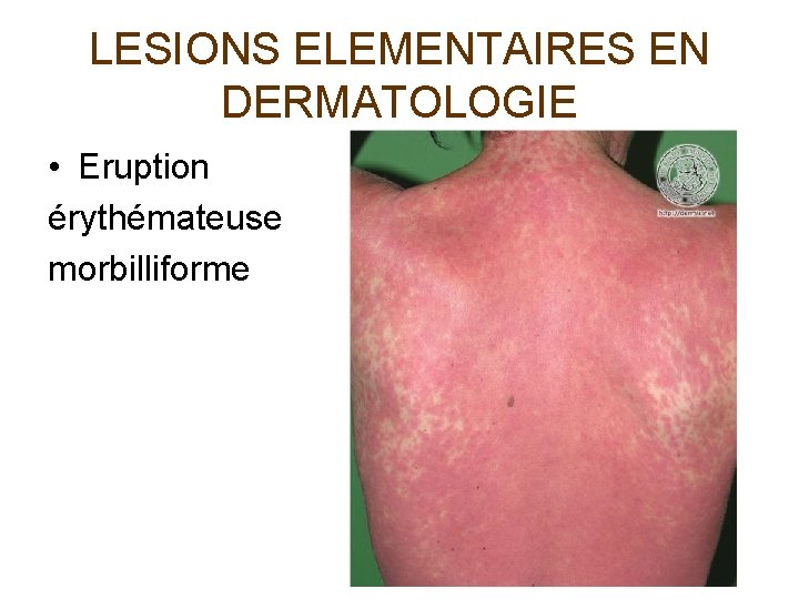 LESIONS ELEMENTAIRES EN DERMATOLOGIE • Eruption érythémateuse morbilliforme 