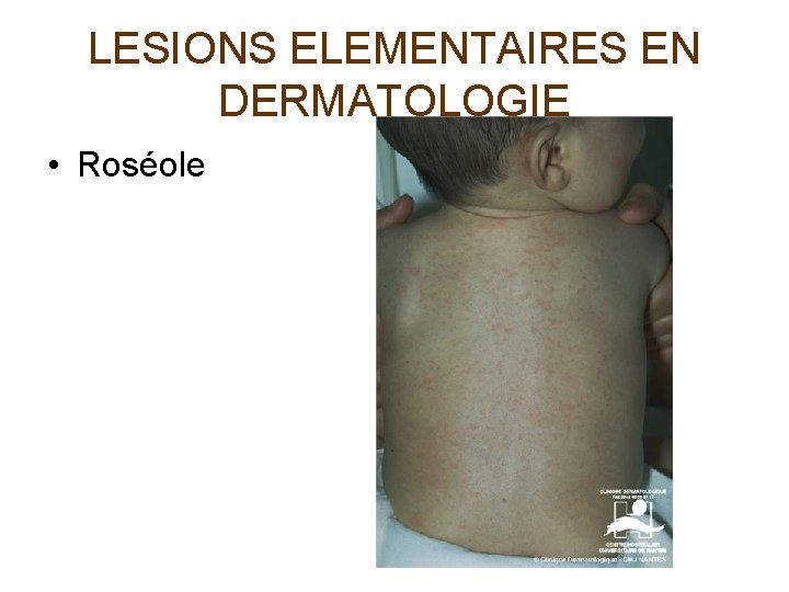 LESIONS ELEMENTAIRES EN DERMATOLOGIE • Roséole 