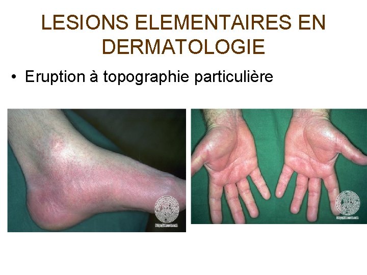 LESIONS ELEMENTAIRES EN DERMATOLOGIE • Eruption à topographie particulière 