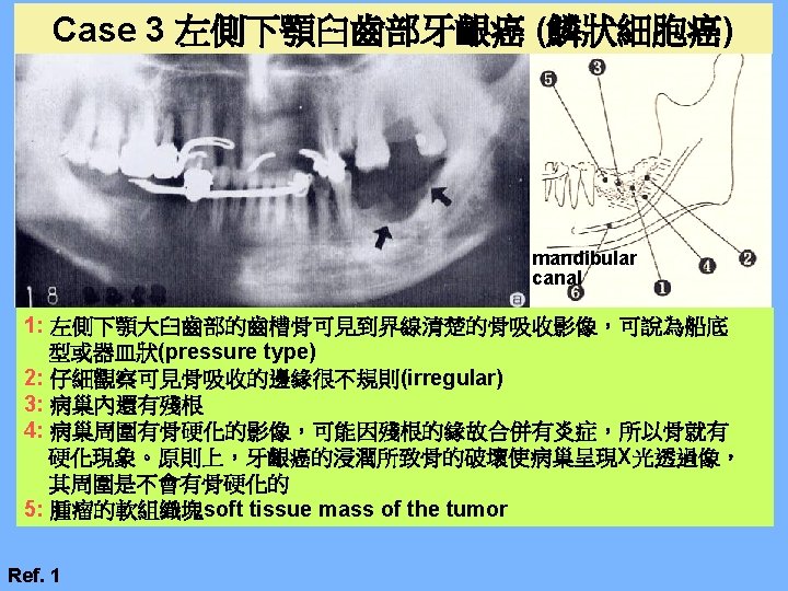 2 Radiologic Interpretation Of Malignant Diseases In Jaws