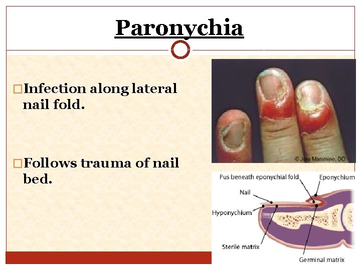 Paronychia �Infection along lateral nail fold. �Follows trauma of nail bed. 