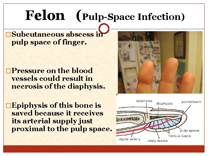 Felon (Pulp-Space Infection) �Subcutaneous abscess in pulp space of finger. �Pressure on the blood