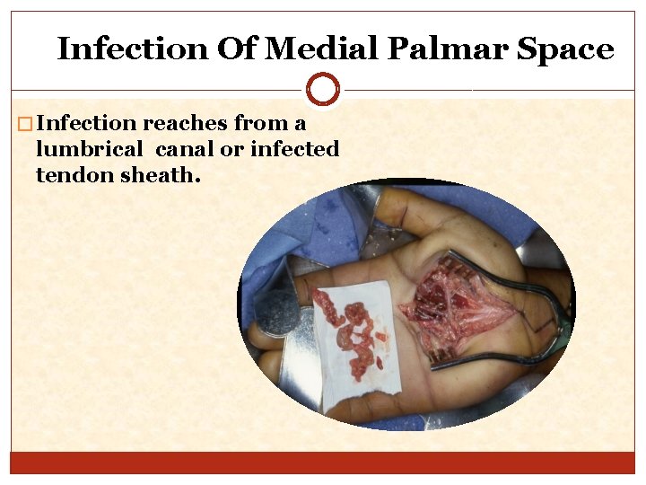 Infection Of Medial Palmar Space � Infection reaches from a lumbrical canal or infected