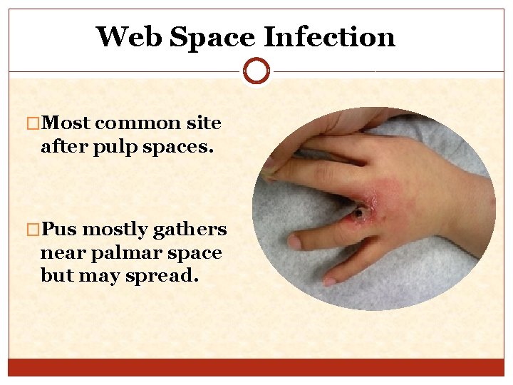 Web Space Infection �Most common site after pulp spaces. �Pus mostly gathers near palmar