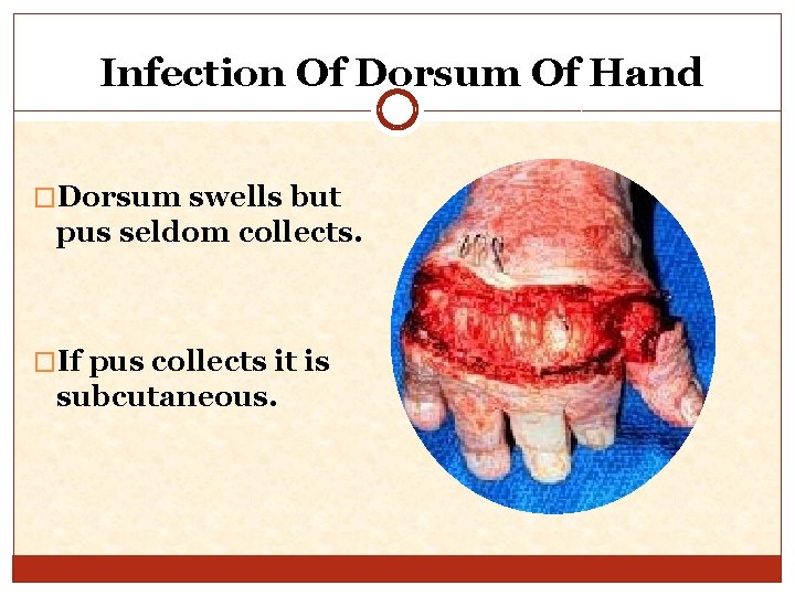 Infection Of Dorsum Of Hand �Dorsum swells but pus seldom collects. �If pus collects