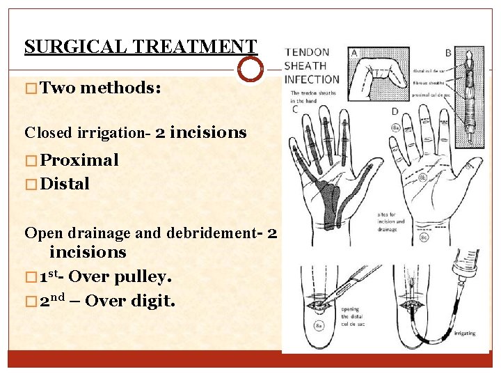 SURGICAL TREATMENT � Two methods: Closed irrigation- 2 incisions � Proximal � Distal Open