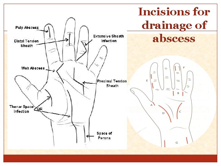 Incisions for drainage of abscess 