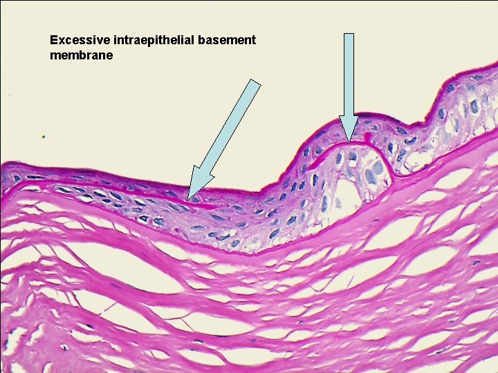 Excessive intraepithelial basement membrane 