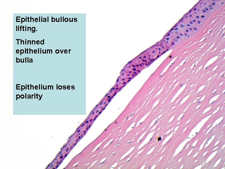 Epithelial bullous lifting. Thinned epithelium over bulla Epithelium loses polarity 