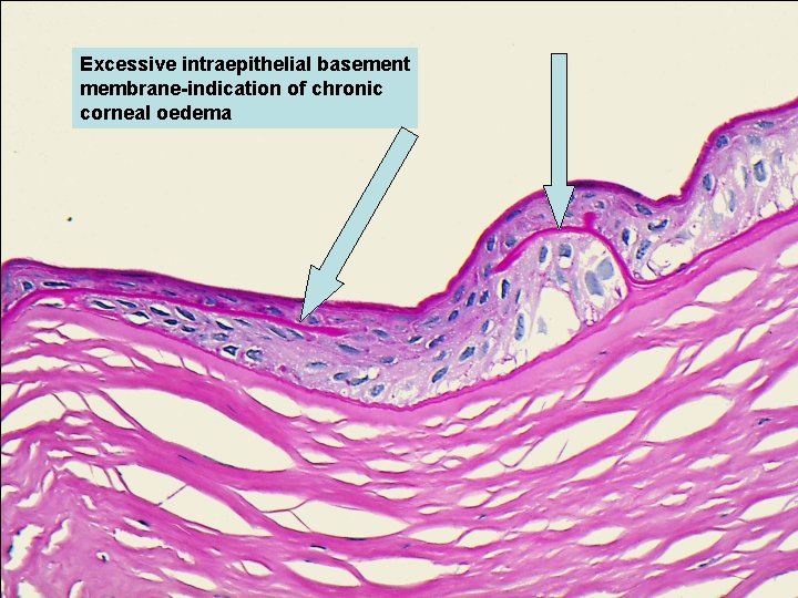 Excessive intraepithelial basement membrane-indication of chronic corneal oedema 