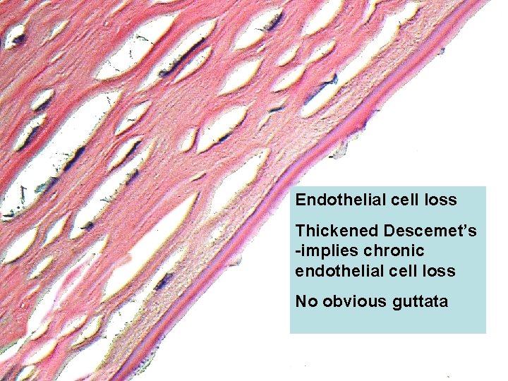 Endothelial cell loss Thickened Descemet’s -implies chronic endothelial cell loss No obvious guttata 