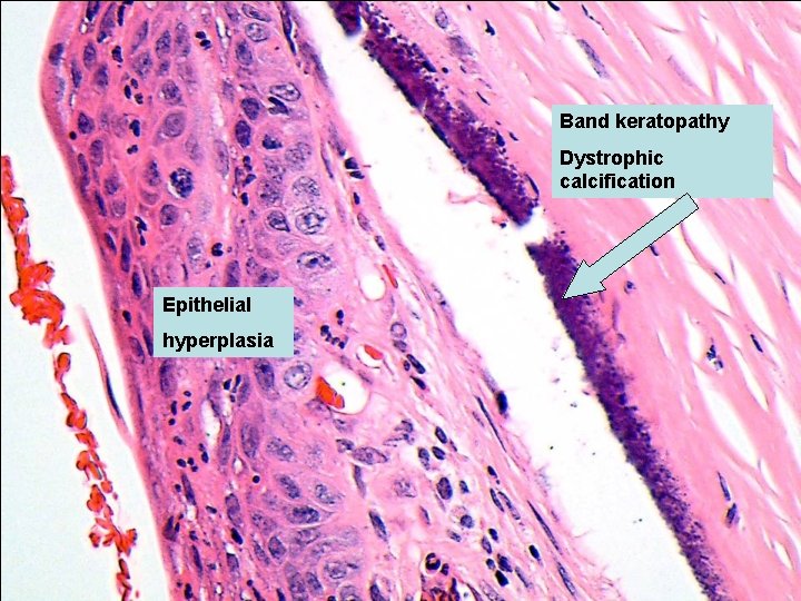 Band keratopathy Dystrophic calcification Epithelial hyperplasia 