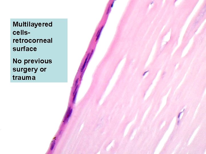 Multilayered cellsretrocorneal surface No previous surgery or trauma 