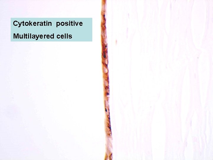 Cytokeratin positive Multilayered cells 