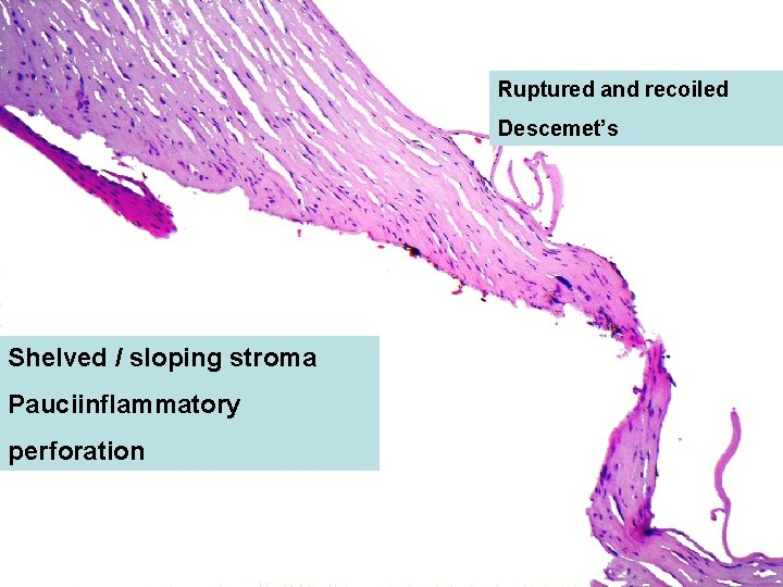 Ruptured and recoiled Descemet’s Shelved / sloping stroma Pauciinflammatory perforation 