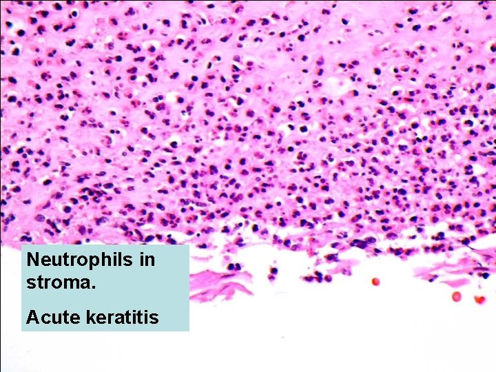 Neutrophils in stroma. Acute keratitis 