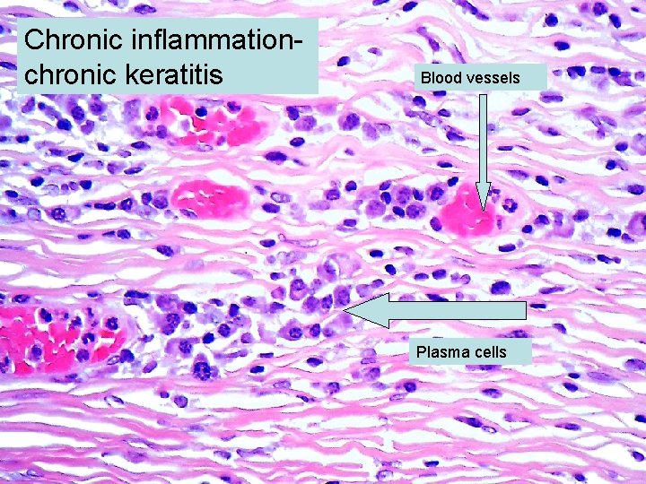 Chronic inflammationchronic keratitis Blood vessels Plasma cells 