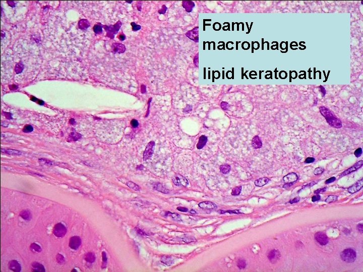 Foamy macrophages lipid keratopathy 