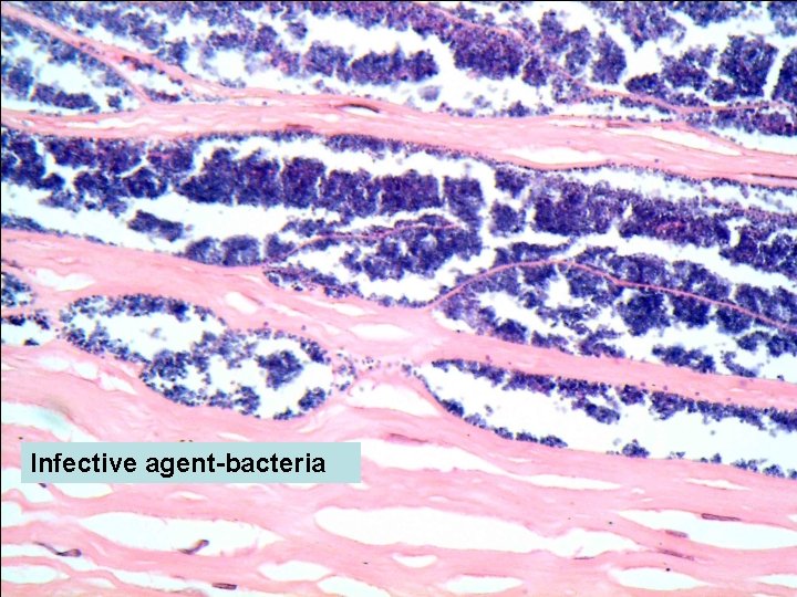 Infective agent-bacteria 