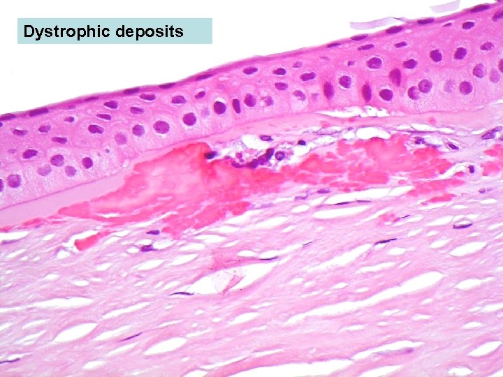 Dystrophic deposits 