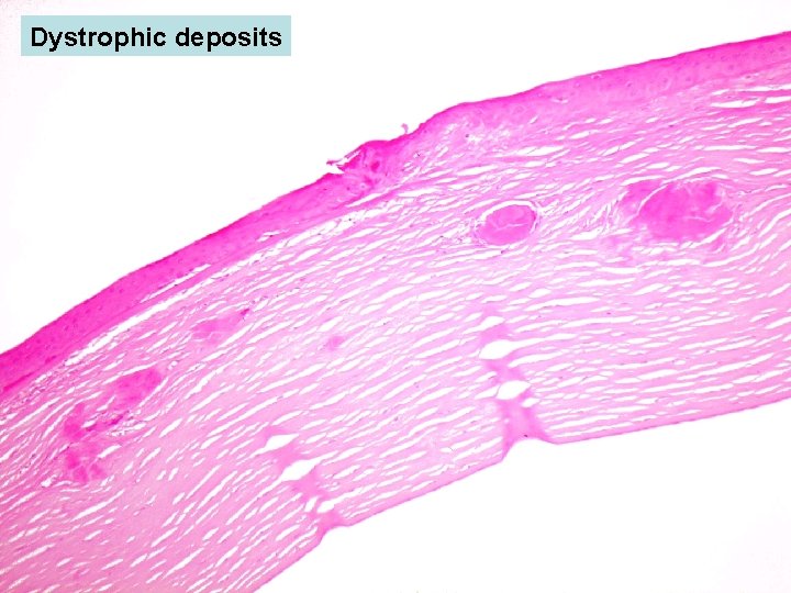 Dystrophic deposits 