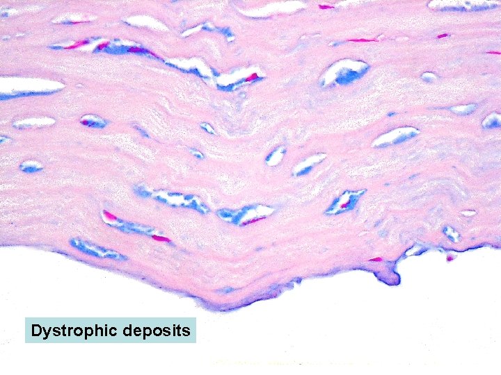 Dystrophic deposits 