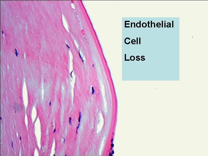 Endothelial Cell Loss 
