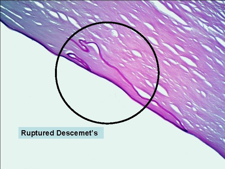 Ruptured Descemet’s 