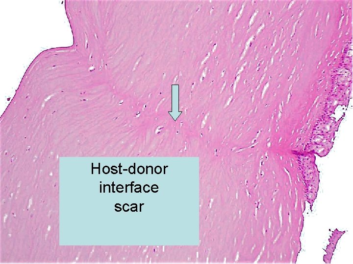 Host-donor interface scar 