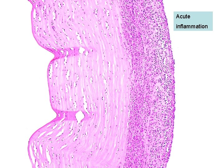 Acute inflammation 