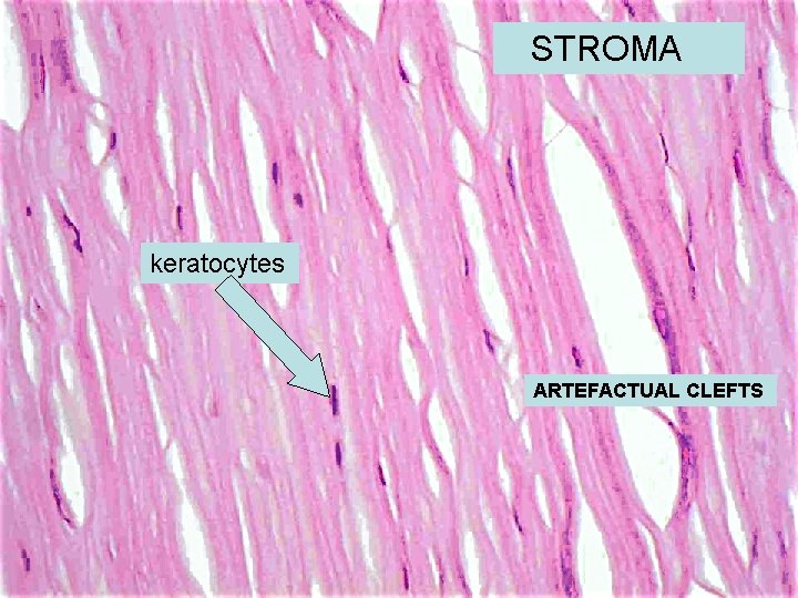 STROMA keratocytes ARTEFACTUAL CLEFTS 