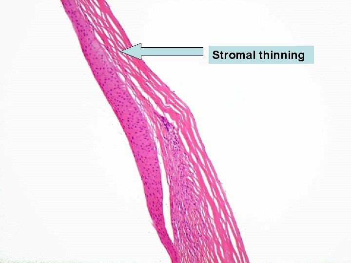 Stromal thinning 