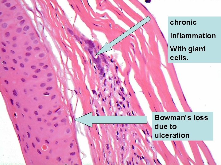 chronic Inflammation With giant cells. Bowman’s loss due to ulceration 