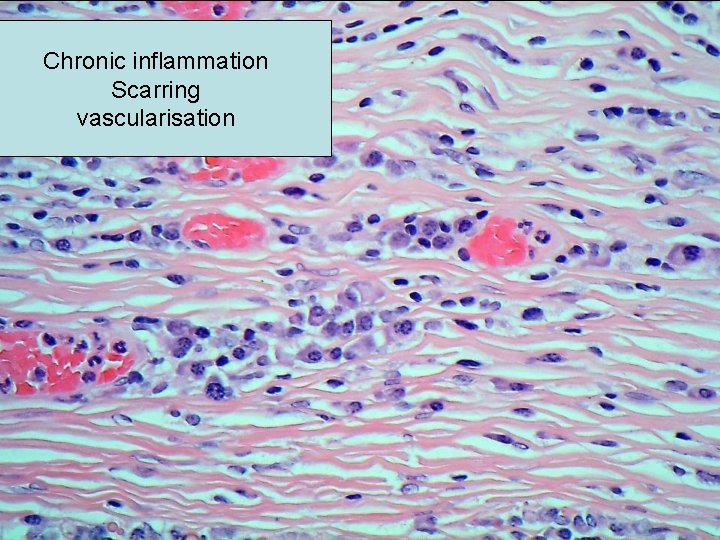 Chronic inflammation Scarring vascularisation 