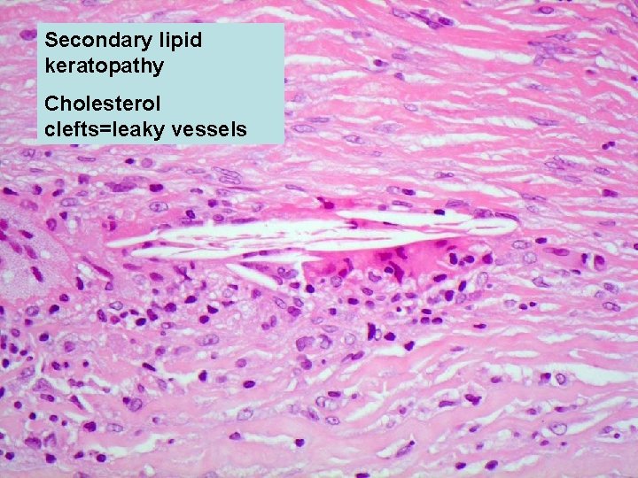 Secondary lipid keratopathy Cholesterol clefts=leaky vessels 