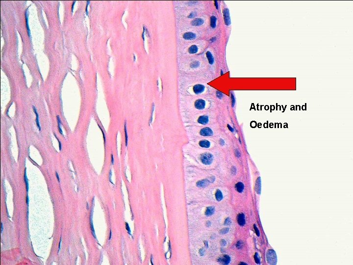 Atrophy and Oedema 