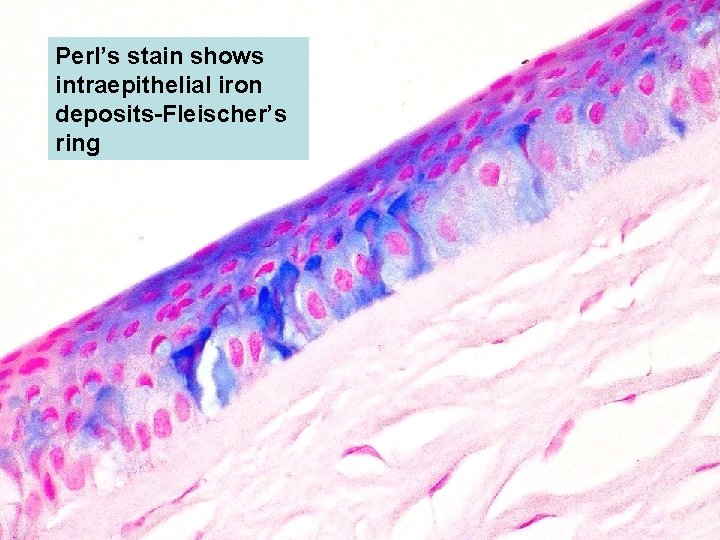 Perl’s stain shows intraepithelial iron deposits-Fleischer’s ring 