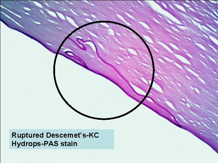 Ruptured Descemet’s-KC Hydrops-PAS stain 