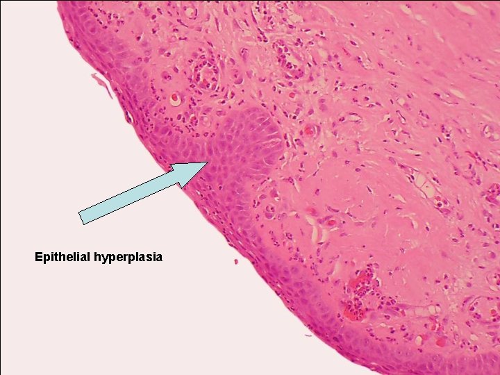 Epithelial hyperplasia 