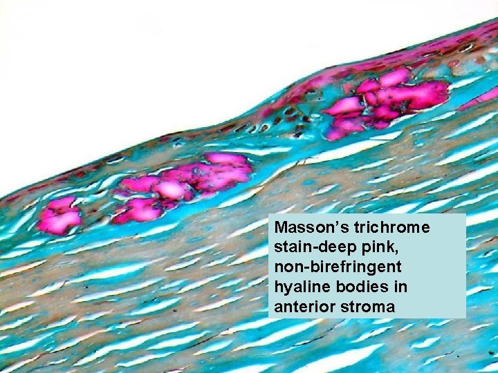 Masson’s trichrome stain-deep pink, non-birefringent hyaline bodies in anterior stroma 