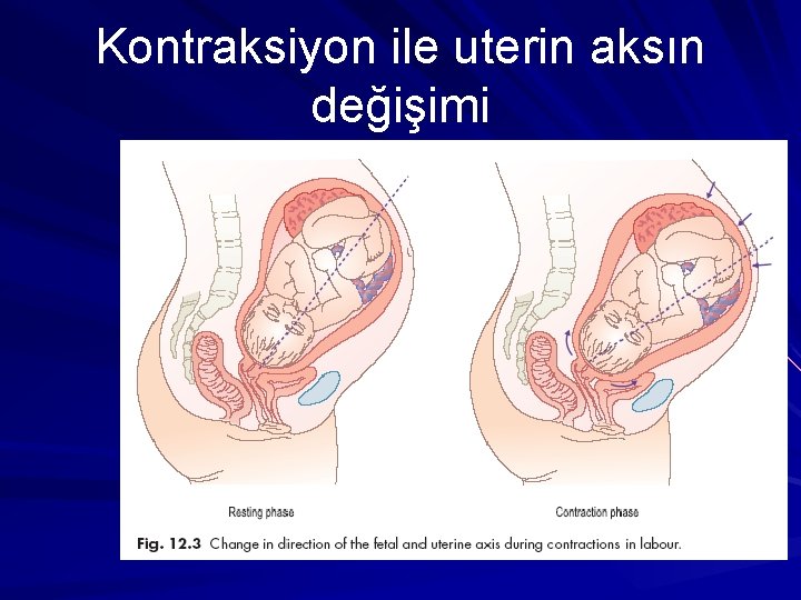 Kontraksiyon ile uterin aksın değişimi 