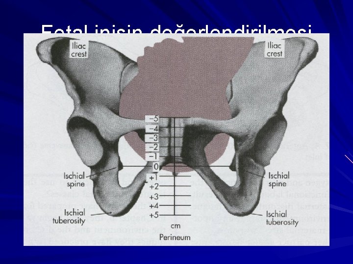 Fetal inişin değerlendirilmesi 
