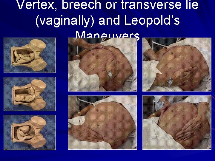 Vertex, breech or transverse lie (vaginally) and Leopold’s Maneuvers 